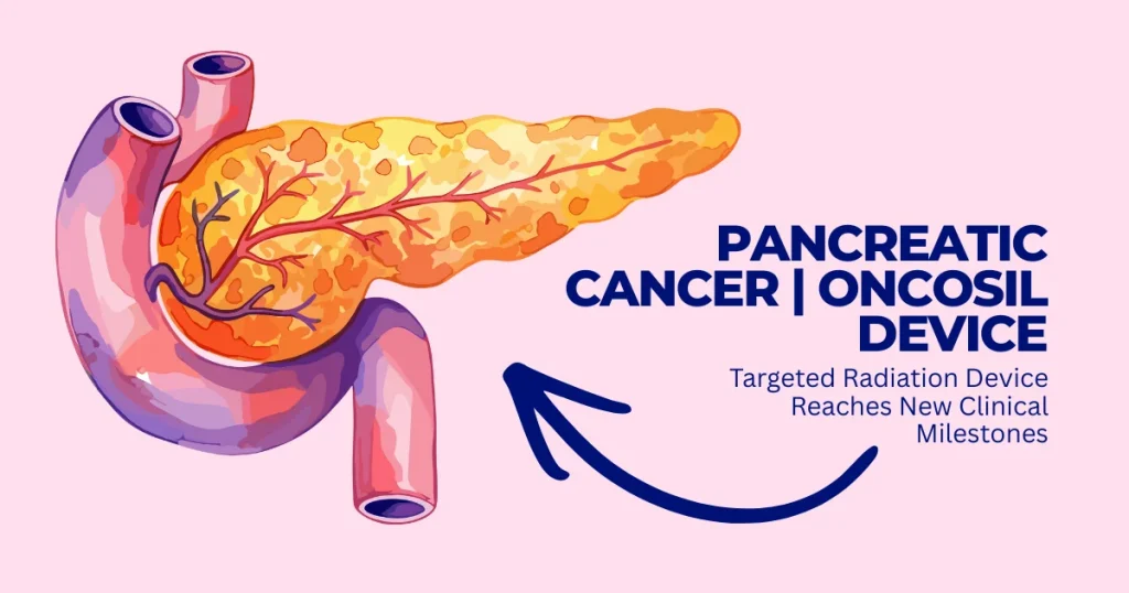 Illustration of a human pancreas with a tumor, highlighting the OncoSil targeted radiation device for pancreatic cancer treatment milestones.